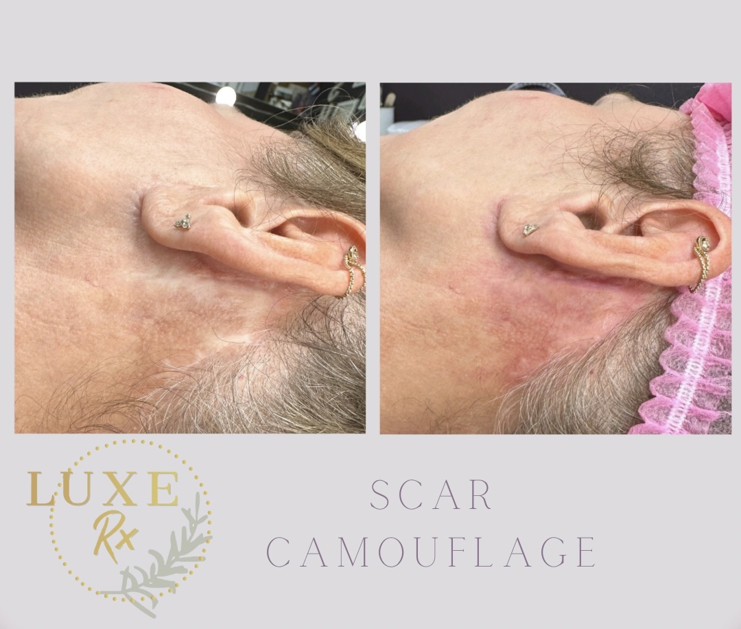 Scar camouflage before-and-after result near the ear