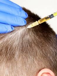 How Platelet-Rich Plasma Therapy Can Reverse Your Hair Loss