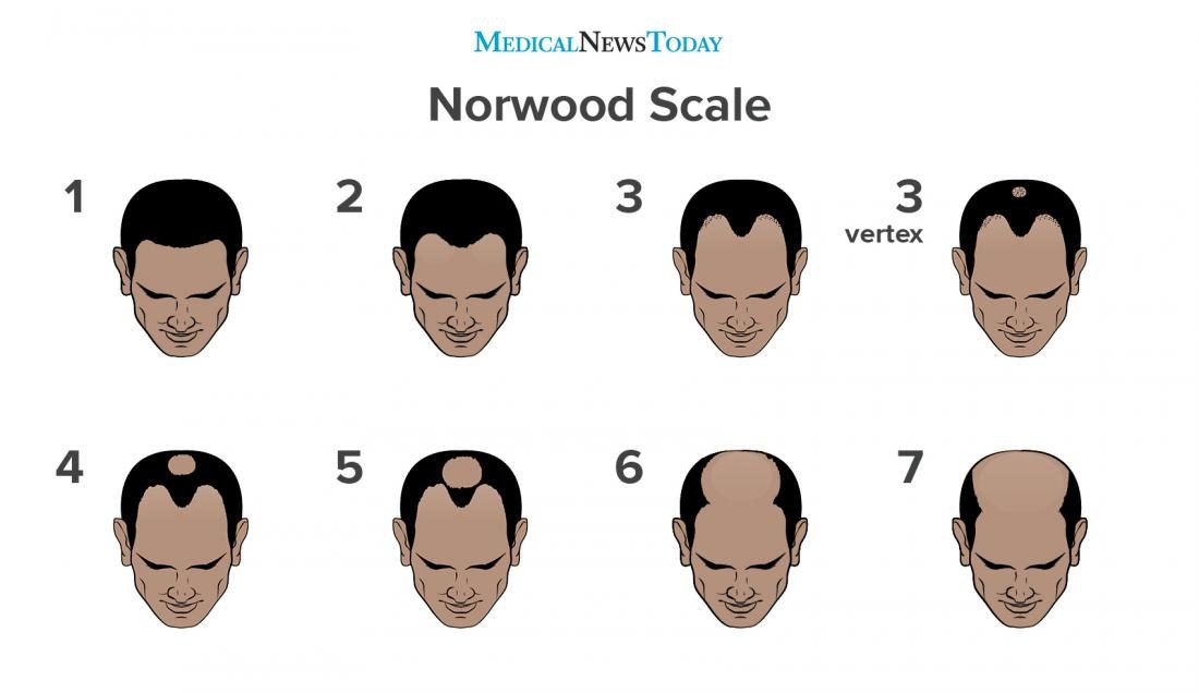 Scalp Micropigmentation