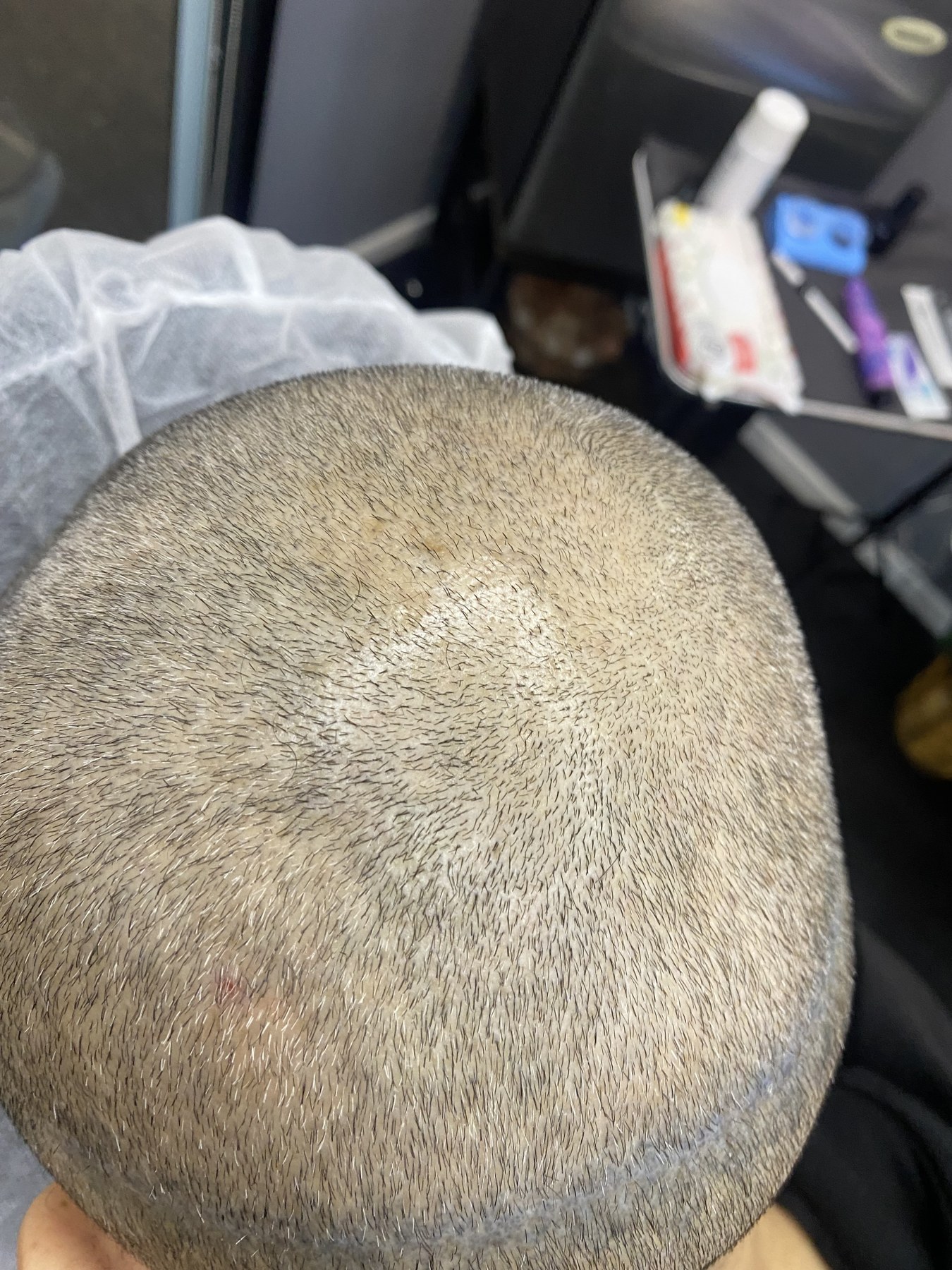 Before crown area scalp micropigmentation
