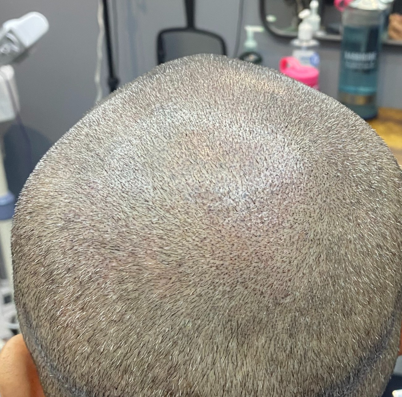 After crown area scalp micropigmentation