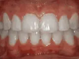 After treatment: Crowding of the teeth