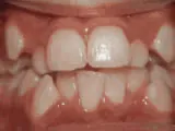 Before treatment: Crowding of the teeth