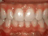 After treatment: Deep overbite