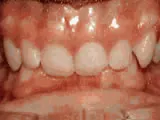 Before treatment: Deep overbite