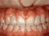 After treatment: Missing lateral incisors