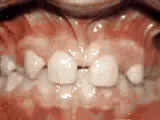Before treatment: Missing lateral incisors
