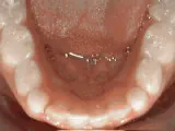 After treatment: Non-braces treatment