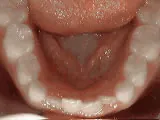 Before treatment: Non-braces treatment