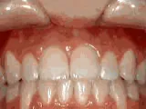 After treatment: Open bite