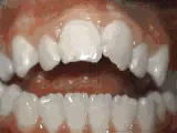 Before treatment: Open bite