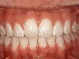After treatment: Overjet