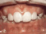 Before treatment: Overjet