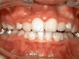 After treatment: Phase-One treatment