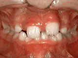 Before treatment: Phase-One treatment