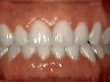 After treatment: Spacing of teeth