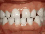Before treatment: Spacing of teeth