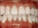 After treatment: Underbite
