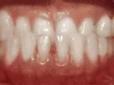 Before treatment: Underbite