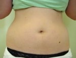 Case #3002 - Body Contouring, before photograph