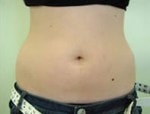 Case #3002 - Body Contouring after photograph