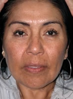 Case #3009 - Thermage, before photograph