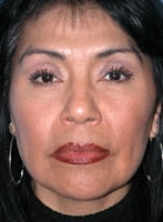 Skin Procedures patient result