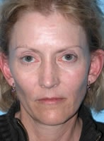 Case #3013 - Thermage, before photograph