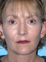 Case #3013 - Thermage after photograph