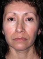 Case #3017 - Thermage, before photograph