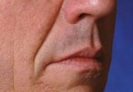 Case #3024 - Restylane®, before photograph