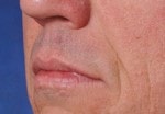 Case #3024 - Restylane®, before photograph