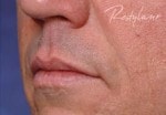 Case #3024 - Restylane®, after photograph