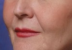 Case #3030 - Restylane®, before photograph