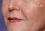 Case #3030 - Restylane® after photograph