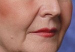Case #3030 - Restylane®, before photograph