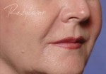 Case #3030 - Restylane®, after photograph