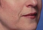 Case #3036 - Restylane®, before photograph