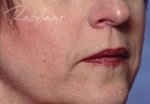 Case #3036 - Restylane® after photograph