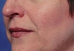Case #3036 - Restylane®, before photograph