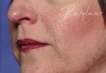 Case #3036 - Restylane®, after photograph