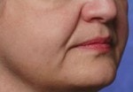 Case #3042 - Restylane®, before photograph