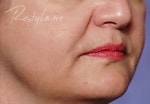 Case #3042 - Restylane® after photograph