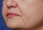 Case #3042 - Restylane®, before photograph