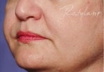 Case #3042 - Restylane®, after photograph