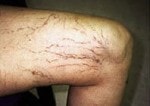 Case #3052 - IPL Spider Veins, before photograph