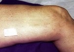 IPL Spider Veins patient result