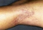 Case #3056 - IPL Spider Veins, before photograph