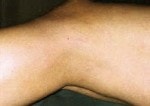 Case #3056 - IPL Spider Veins after photograph