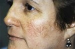 Case #3060 - IPL Spider Veins, before photograph